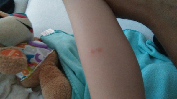 Aké fľaky to má moje dieťa na nožičke?