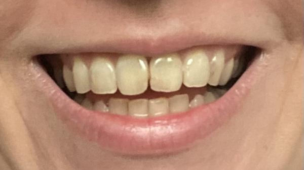 Zirkónové zuby: Oplatí sa do nich investovať?