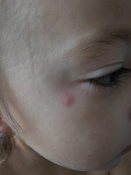 Môžu to byť kiahne?