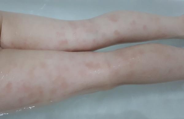 Ako liečiť červené fľaky na nohách trojročnej dcérky?