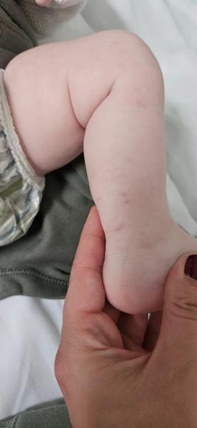 Čo spôsobuje modriny u trojmesačného dieťaťa?