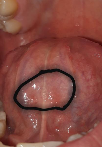 Hrčka pod jazykom, čo to môže byť?