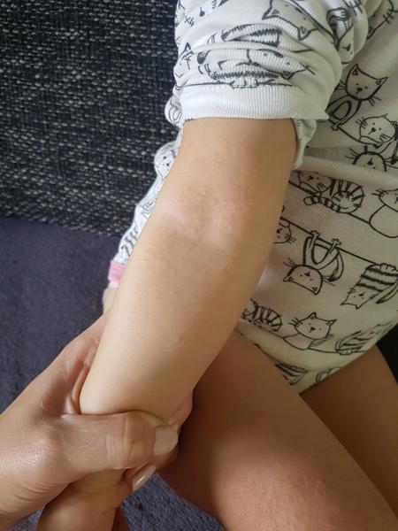 Poznáte takýto ekzém?