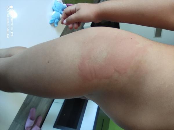 Má moja dcéra alergický výsyp?