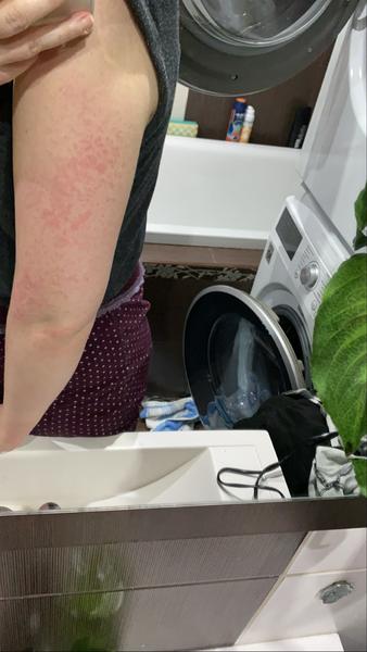 Aké červené fľaky to mám na rukách?