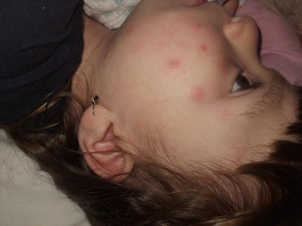 Prečo má dcéra fľaky na tvári?