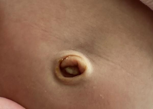 Je odpadnutý pupček s dierkou normálny?