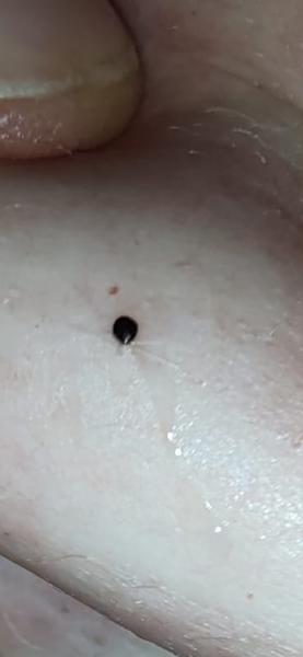 Čo spôsobuje svrbenie na koži?