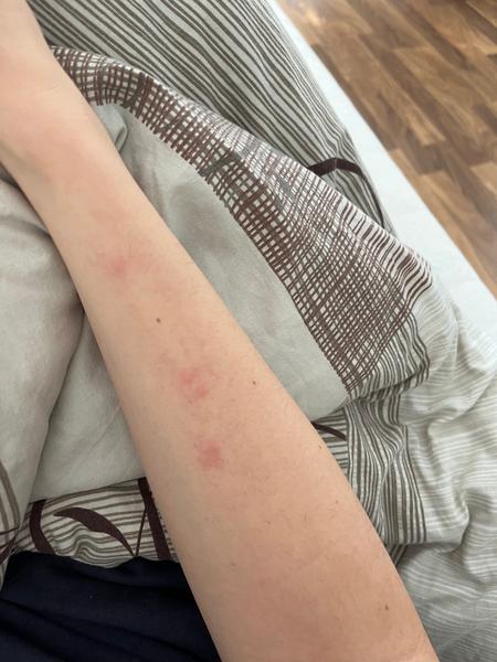 Antibiotiká a výsyp na rukách