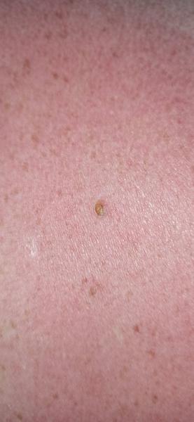 Ako rozoznať neznáme znamienko na koži?