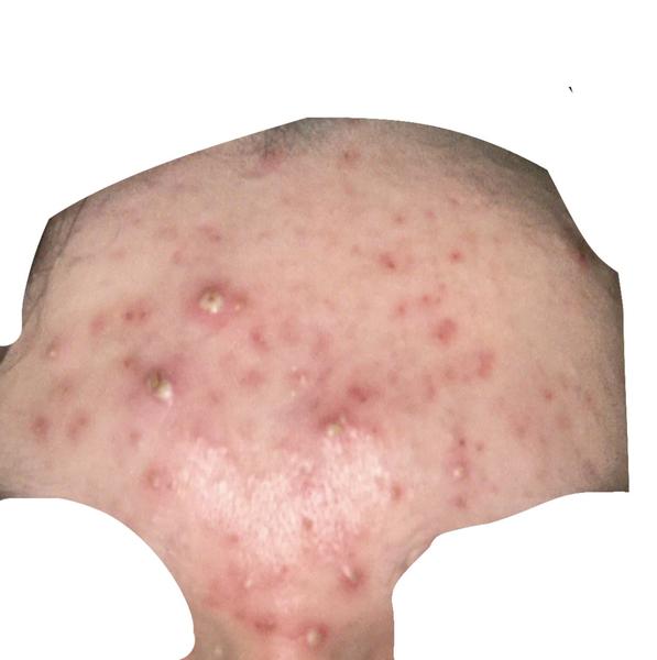 Zlá pleť po vyčistení od kozmetičky