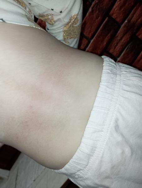 Z čoho sa vytvorili dcérke takéto svrbivé vyrážky?