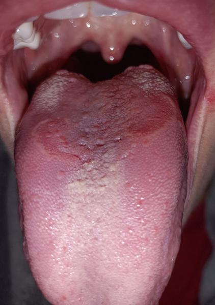 Čo robiť pri bolestiach jazyka?