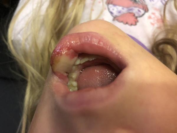 Prečo má dcéra opuchnutú peru po ošetrení kazu?