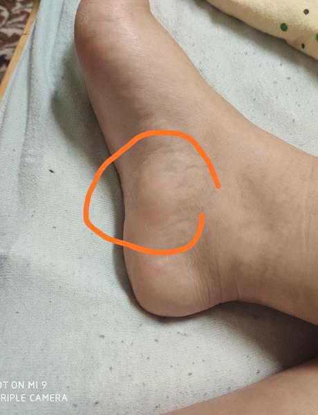 Bolesť pät a opuchy