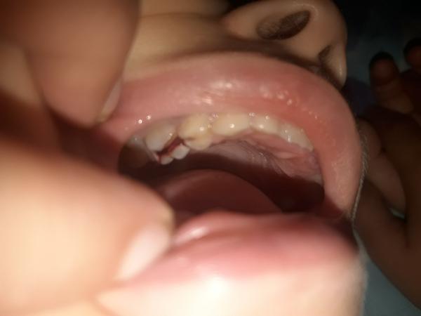 Ako umývať 6 ročnej dcérke zub, ktorý ju veľmi bolí?