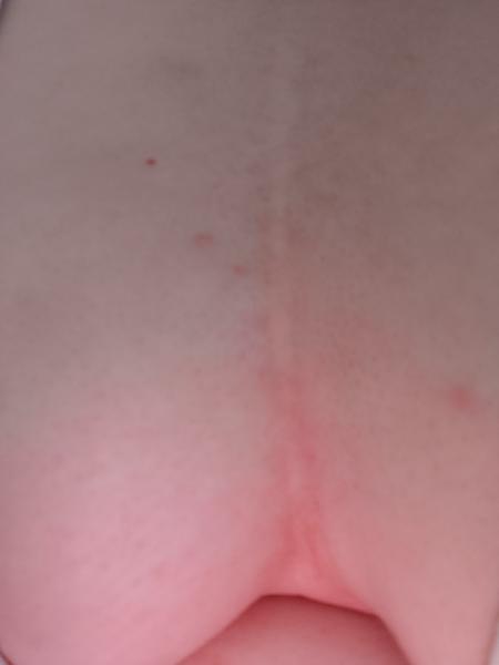 Čo robiť pri svrbení starej jazvy?