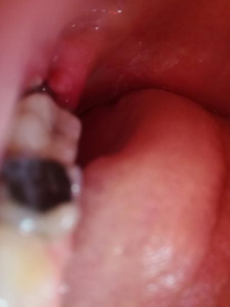 Opuch sánky. Môže ísť o zápal okostnice?