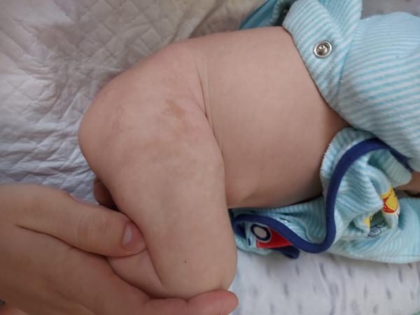 Aké fľaky to má moje štvortýždňové dieťa?