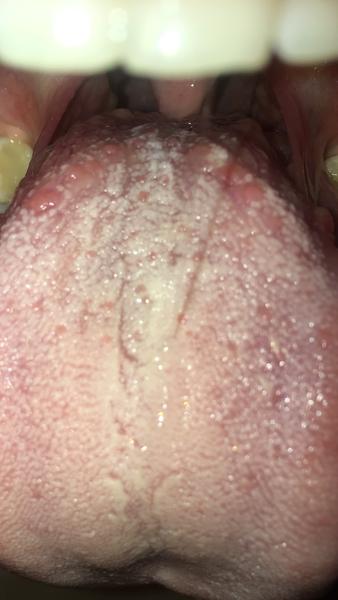 Na jazyku sa mi objavili hrudky. O aký problém môže ísť?