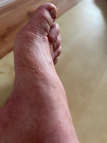 Môže ísť o dyshidrotický ekzém?