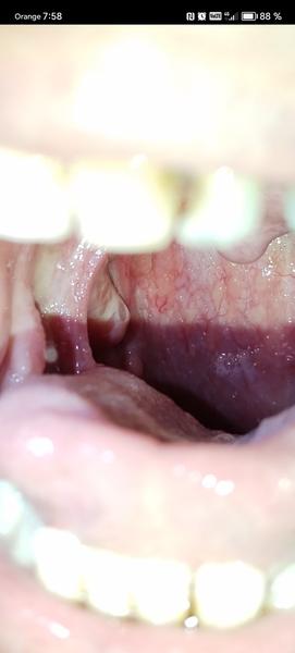 Mali ste skúsenosť s hrčkou v hrdle pri mandli?