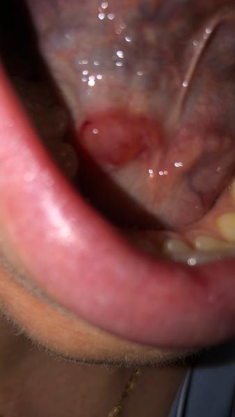 Čo môže byť pod jazykom?