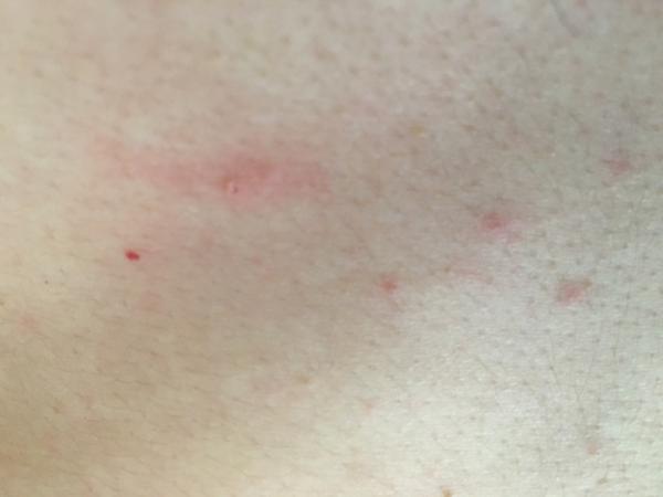 Prečo sa mi na tele tvoria takéto vyrážky?