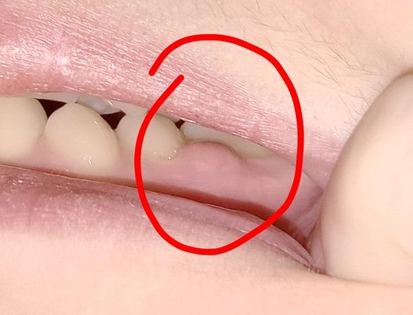 Čo znamená útvar na ďasne medzi zubami?