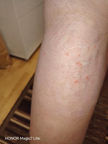 Čo spôsobilo vyrážky po návrate z Turecka?