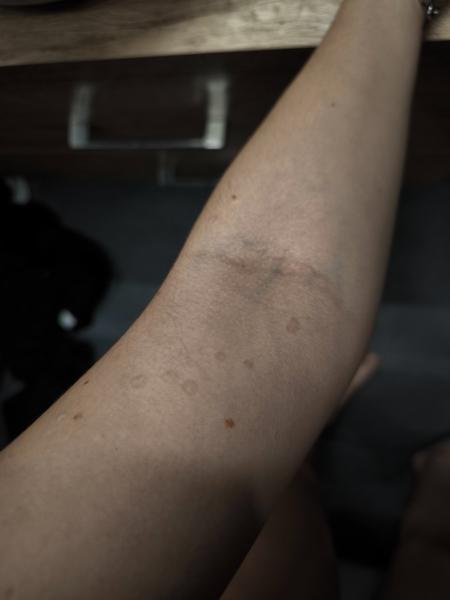 Môžu fľaky na rukách súvisieť s tehotenstvom?