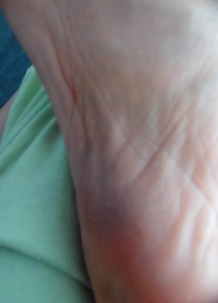 Obávam sa nežiadúcich účinkov antibiotík. Musím ich nutne užívať?