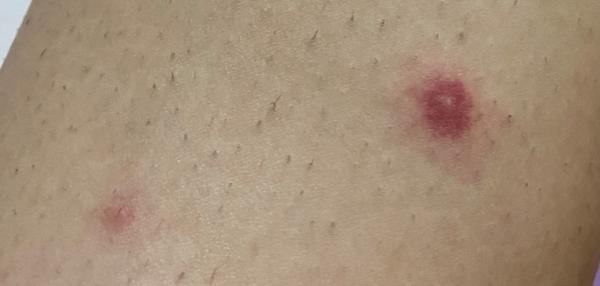 Po nohách sa mi robia takéto vyrážky