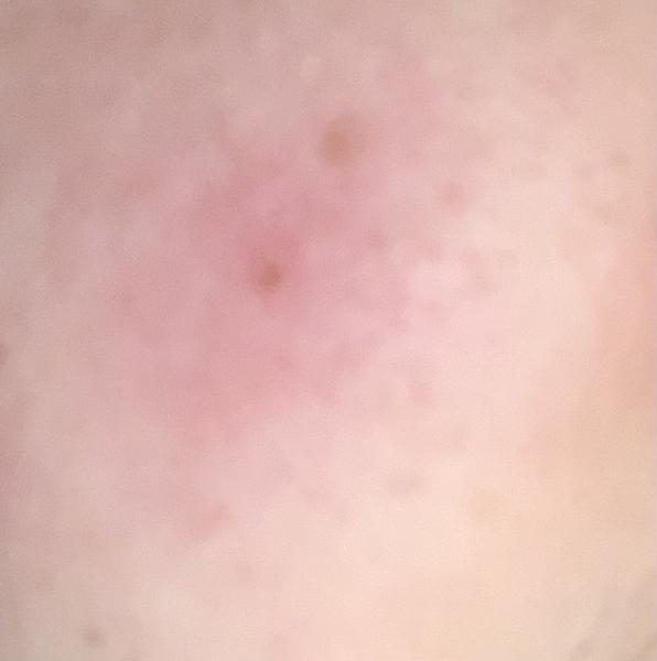 Domáce recepty na červenú pokožku po vytlačení pupienka