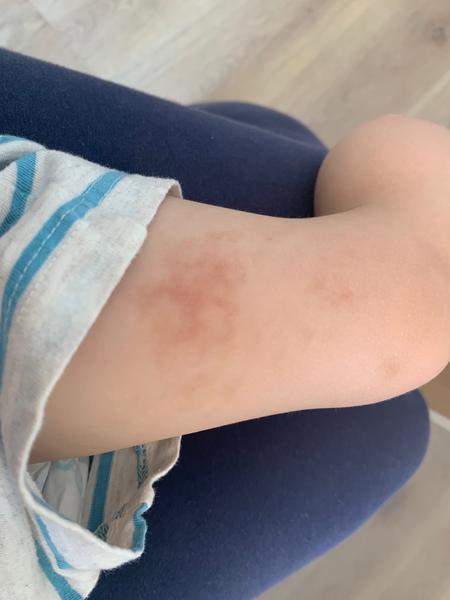 Akú modrinu má moje 1,5 ročné dieťa na stehne?