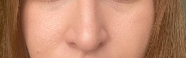 Ako sa zbaviť dier na lícach?