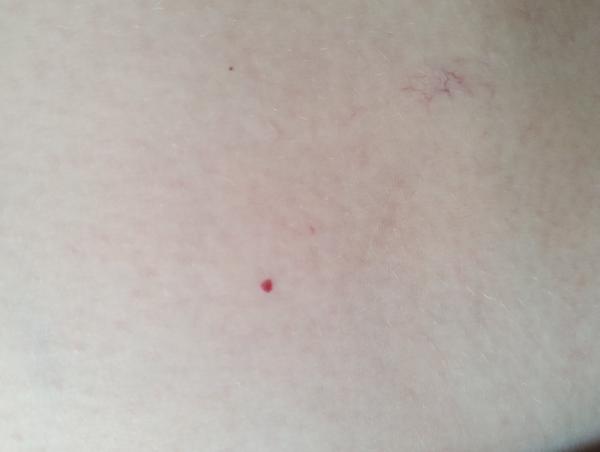 Majú drobné žilky a znamienka zdravotný význam?