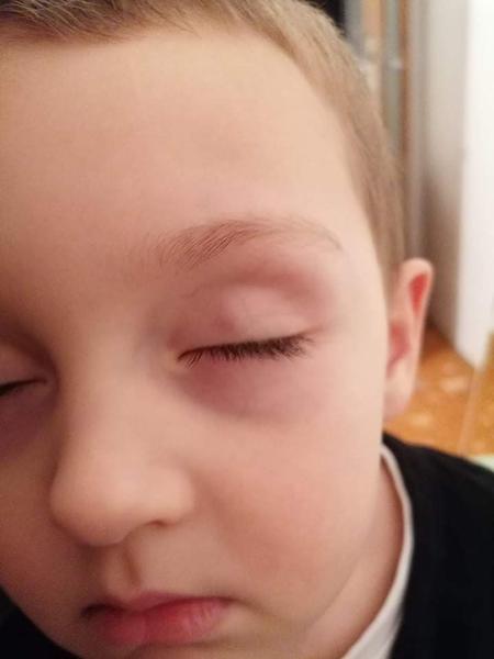 Akú hrčku má môj štvorročný syn na hornom viečku?