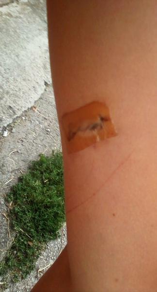 Môžem zmeniť dcére leukoplast po vyberaní znamienka?