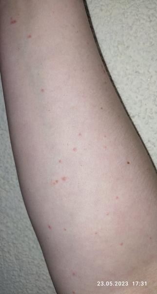 Je to alergia na lieky?