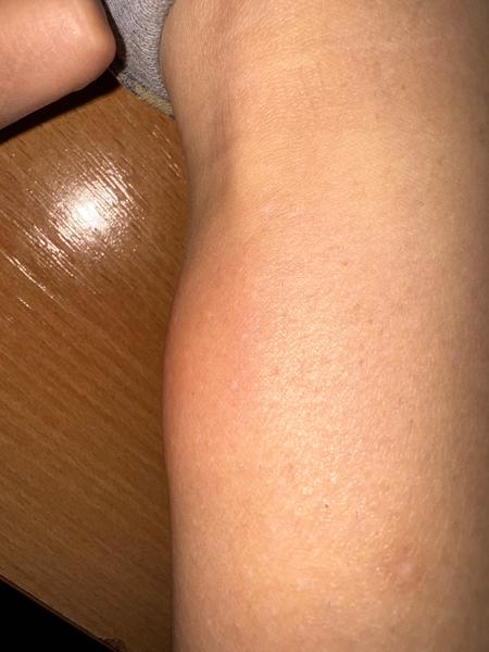 Kliešťová katastrofa: Je opuch dôvod na obavy?