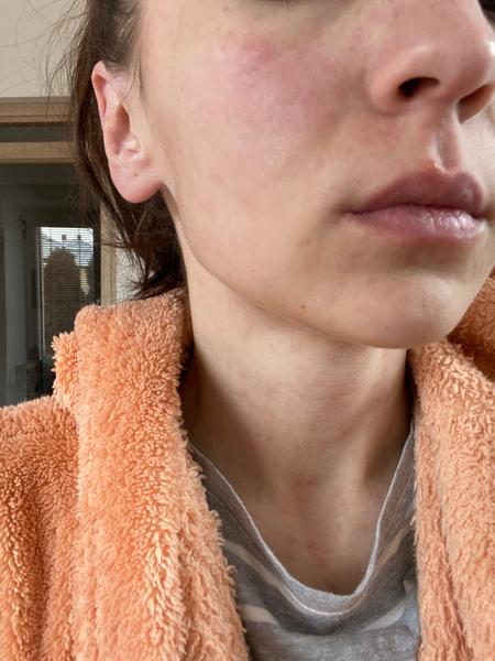 Môže ísť o histamínovú intoleranciu?