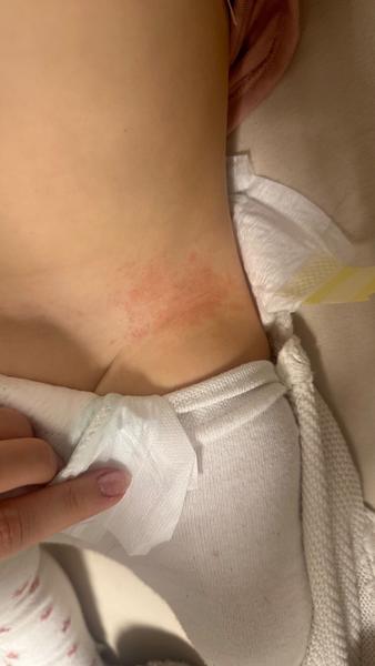 Ako liečiť dlhodobé vyrážky na boku u dieťaťa?