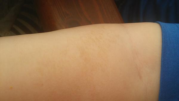 2,5 ročný syn má suchú kožu na predlaktí. Čo to je?