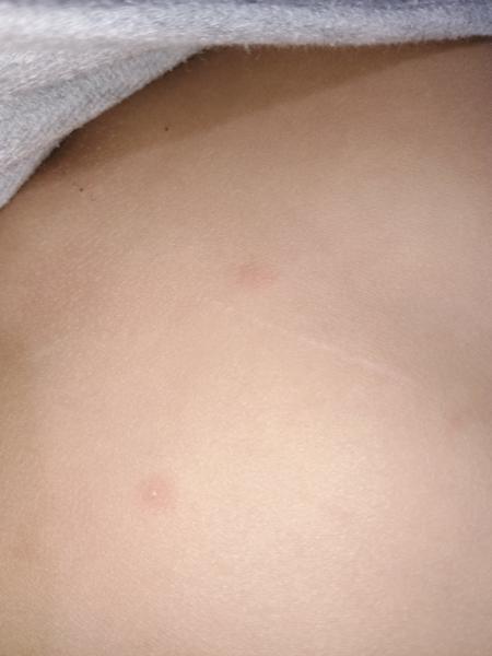 Sú to kiahne alebo nie? Ako postupovať?