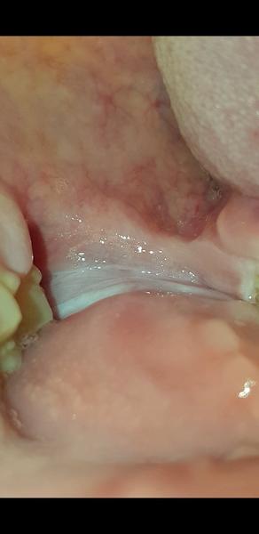 Prečo mám biely povlak v ústnej dutine?