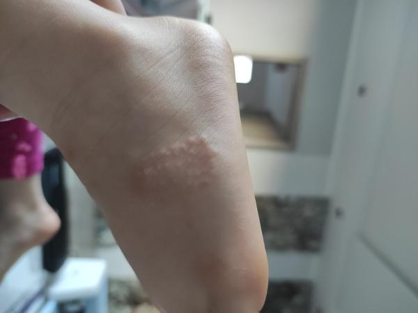 O aké vyrážky na nohe ide?