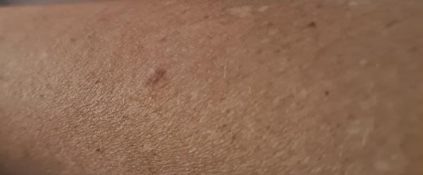 Urobila sa mi pigmentové škvrna?