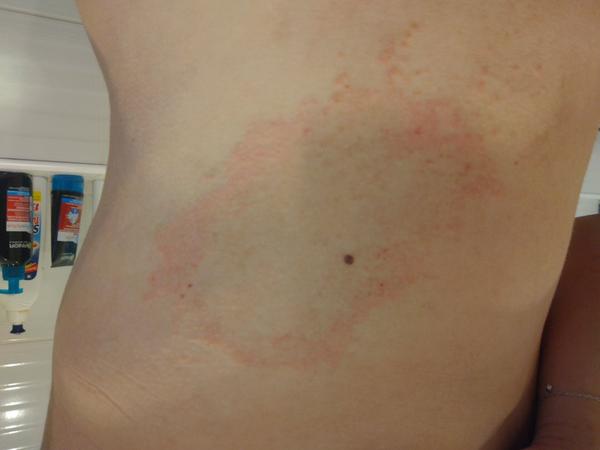 Rozrastajúci sa fľak prstencového tvaru