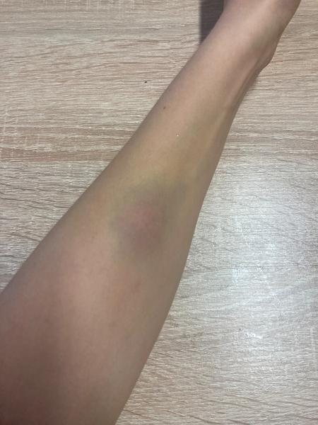 Je to prasknutá žilka alebo od hmyzu?